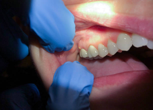 Best Emergency Dentist for Lost Fillings or Crowns in Jackson, MI