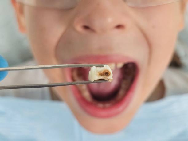 Best Broken or Cracked Tooth Emergency Dentist in Jackson, MI